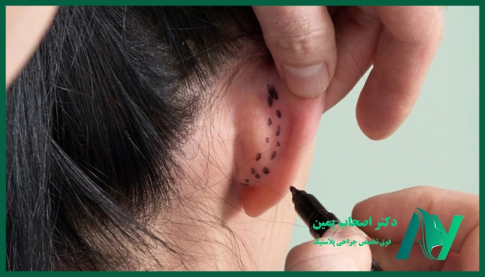 مزایای عمل جراحی زیبایی گوش
