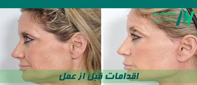 اقدامات قبل از عمل