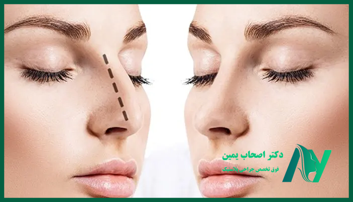 جراحی قوز بینی