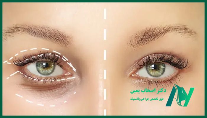 مراقبت های بعداز بلفاروپلاستی