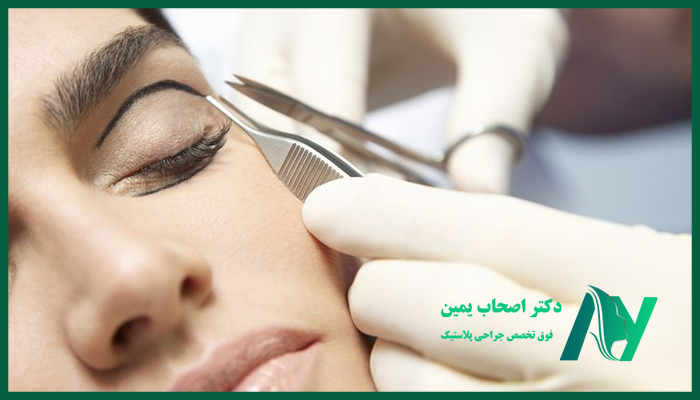 نکات مهم مراقبتی بعد از بلفاروپلاستی