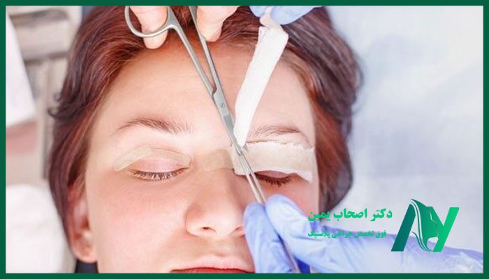 نکاتی که بعد از جراحی زیبایی پلک باید رعایت شود