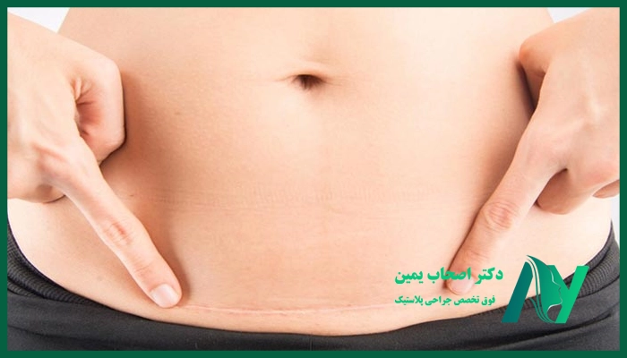 درمان خارش بعد از عمل ابدومینوپلاستی