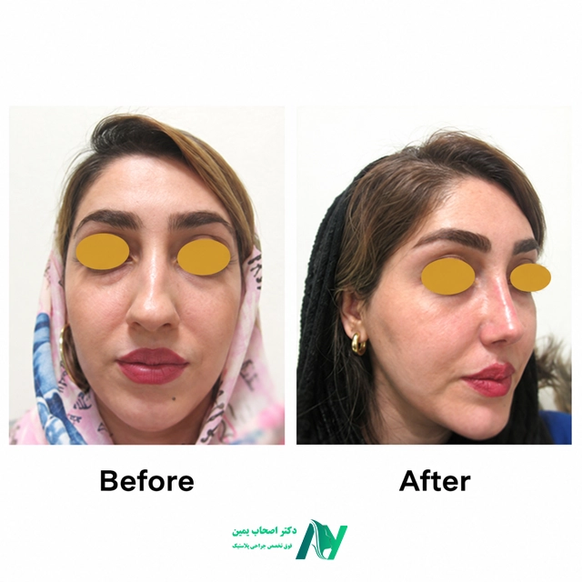 نمونه کار جراحی بینی استخوانی دکتر اصحاب یمین